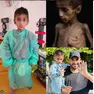 Il piccolo Osama, curato all'ospedale di Verona
