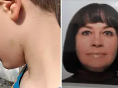 A sinistra il livido sul collo del figlio nell'aggressione di giugno del 2023, a destra Olena Stasiuk