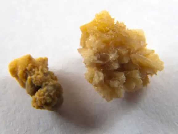 I ladri hanno rubato due calcoli renali, presumibilmente scambiandoli per pietre preziose