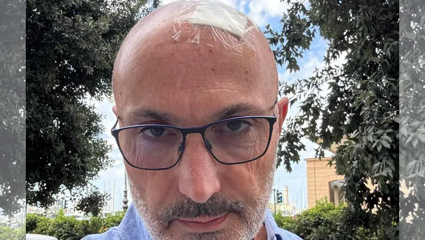 Fabio Carini con il capo fasciato dopo essere stato colpito da un bastone caduto dal terzo piano