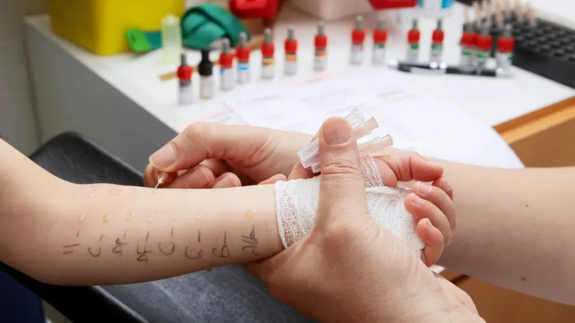 Il test per le allergie effettuato su un bambino